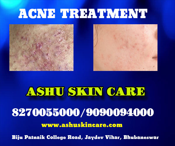 best acne and pimple treatment clinic in bhubaneswar close to kar hospital